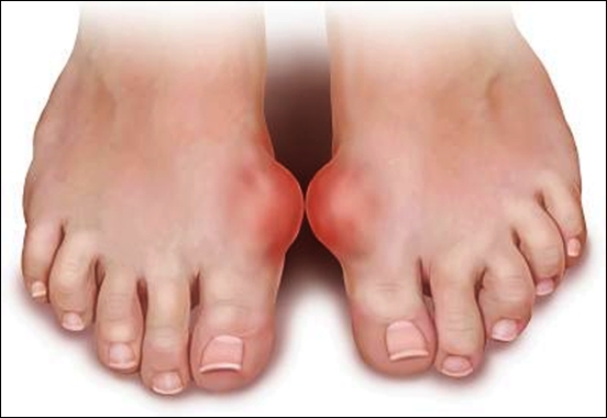 Bệnh gout hình thành do lắng đọng axit uric tại khớp