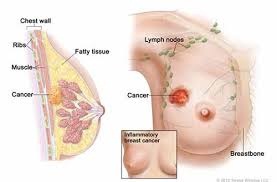 Hình ảnh ung thư vú