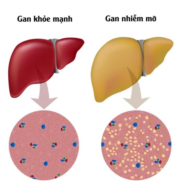 Hình ảnh so sánh giữa gan khỏe mạnh và gan nhiễm mỡ