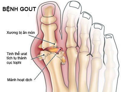 Hình ảnh bệnh Gout ở bàn chân